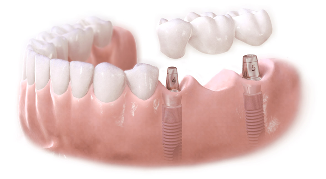 Implante dental