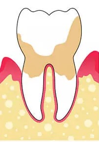 periodontitis avanzada