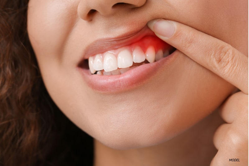 periodontitis